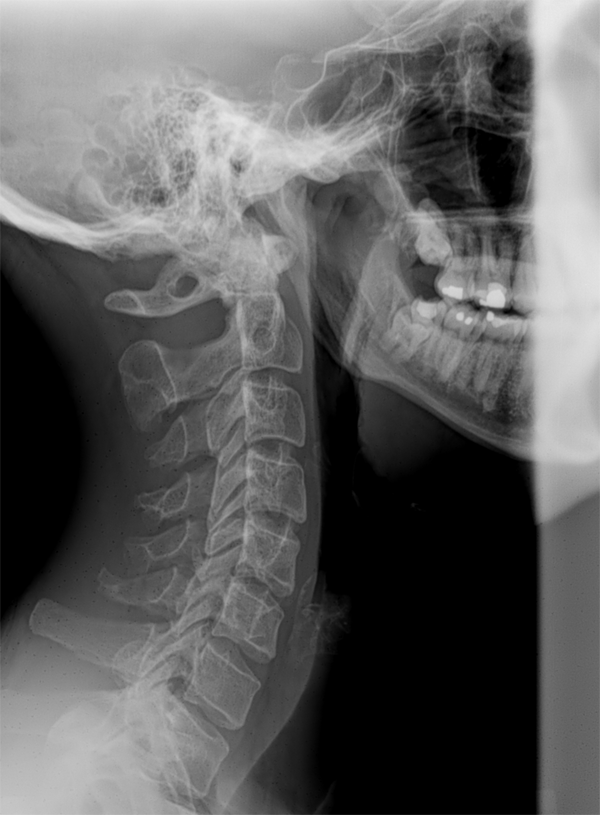 do chiropractors take x rays